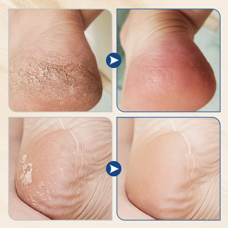 Crème hydratante et anti-gerçures pour les pieds